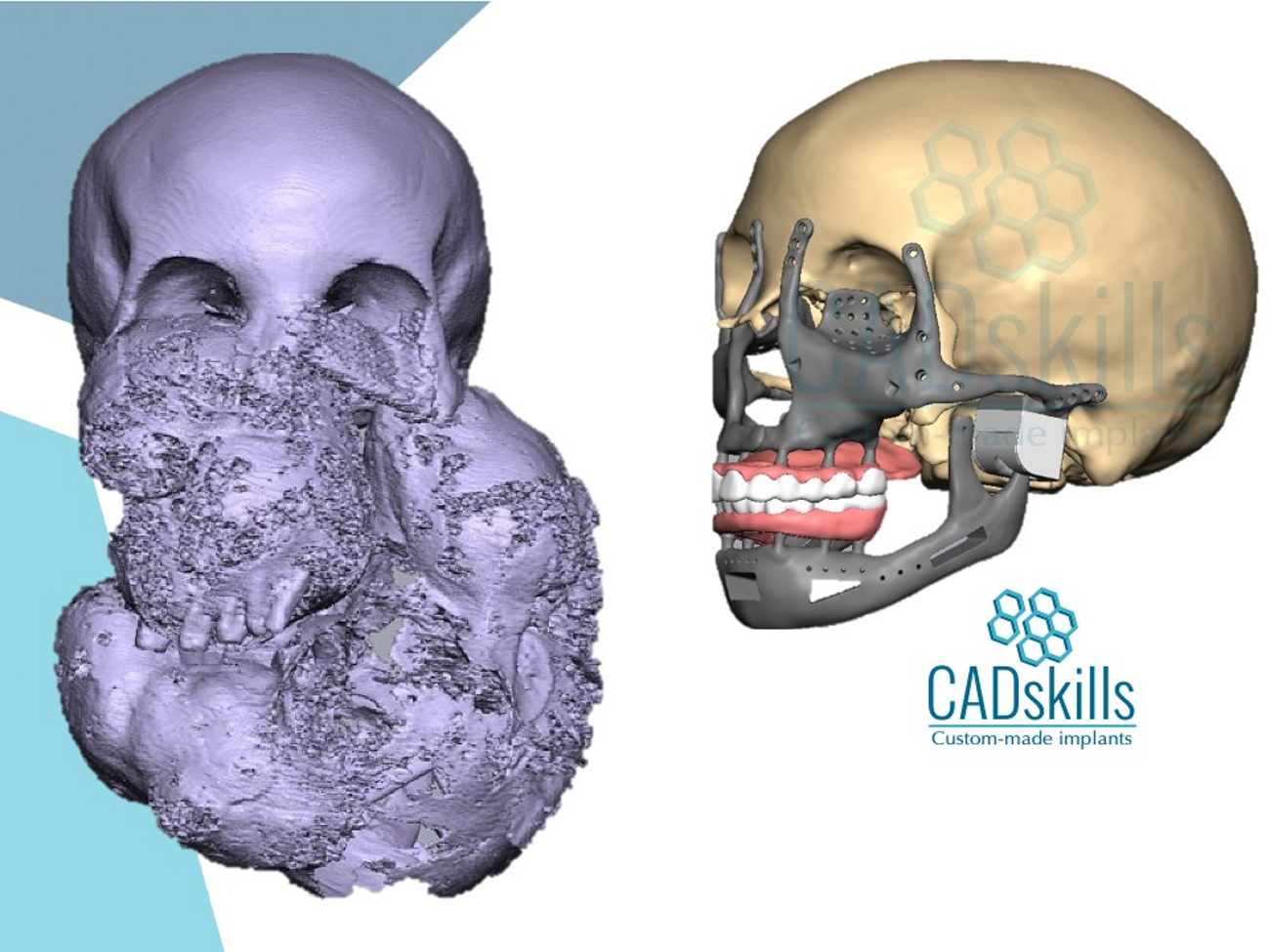 Squelette facial complet imprimé en 3D