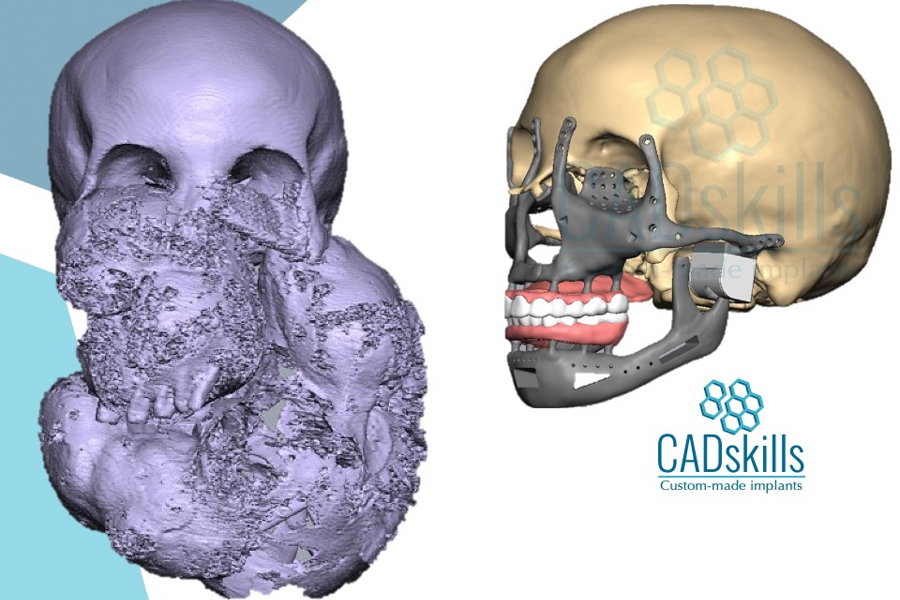 Esqueleto facial total impreso en 3D